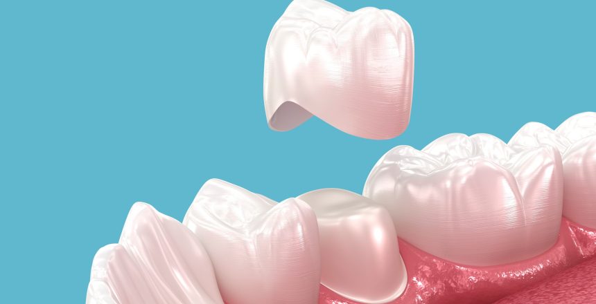 Dental,Crown,Placement,Over,Tooth.,3d,Illustration